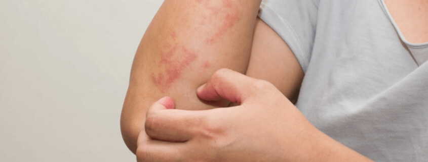 Banish your Eczema with Food Sensitivity Testing