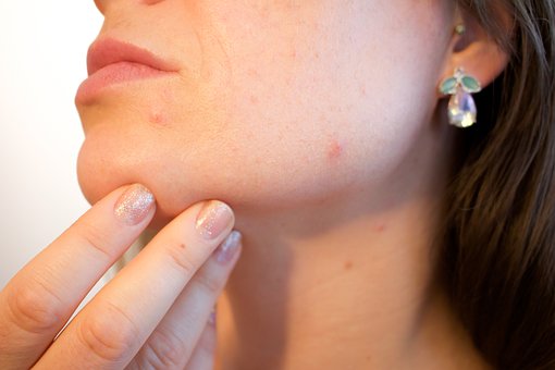 Can an Intolerance Test Help my Acne?