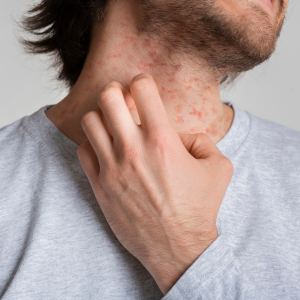 scratching neck 300x300 - Strawberry Allergy Guide